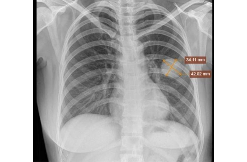 Hình ảnh chụp phổi trái: Nhu mô thùy dưới phổi trái có khối mờ kích thước 34x42mm, bờ đều, sau sinh thiết, hiện không thấy tràn khí màng phổi.