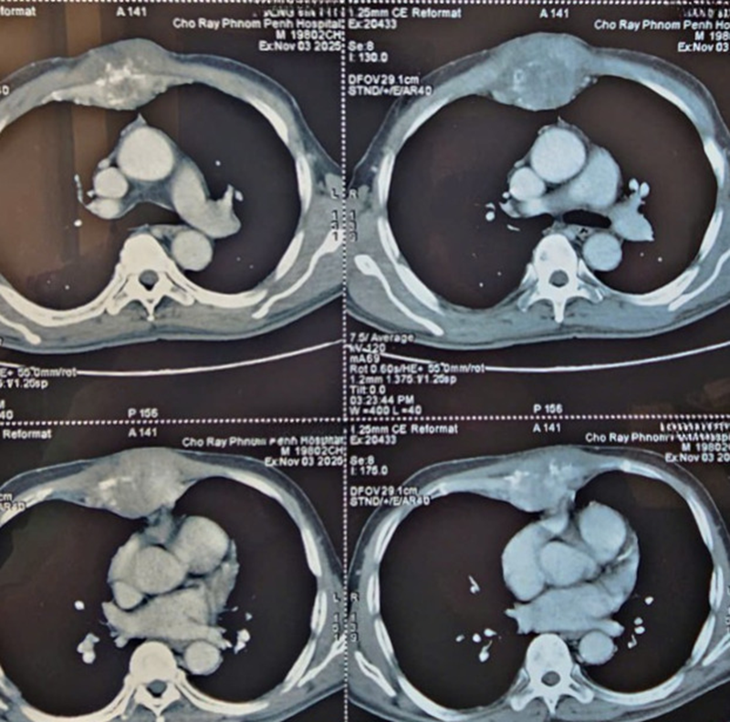 Hình ảnh chụp CT của bệnh nhân được thực hiện tại Bệnh viện Chợ Rẫy Phnom Penh