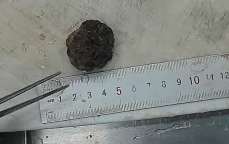 Bệnh phẩm khối kích thước 3x2,5x1cm, mặt cắt màu nâu đen, mật độ chắc, xen kẽ các vùng màu vàng mềm