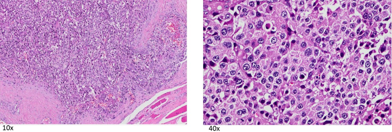 Hình ảnh bên trái là các tế bào u sắp xếp tạo cấu trúc thành từng dải, từng bè, xâm nhập vào mô đệm; Hình ảnh bên phải, các tế bào u có hình đa diện với nhân lớn, tăng sắc, bào tương rộng ưa toan, có hạt nhân rõ