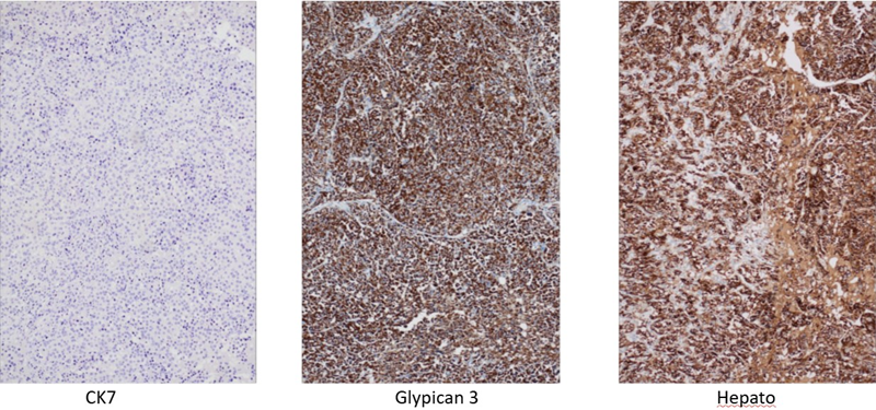 Nhuộm hóa mô miễn dịch cho thấy dương tính mạnh, lan tỏa với Glypican-3 và dương tính với Hepatocyte (2 dấu ấn hóa mô miễn dịch đặc hiệu của ung thư biểu mô tế bào gan)