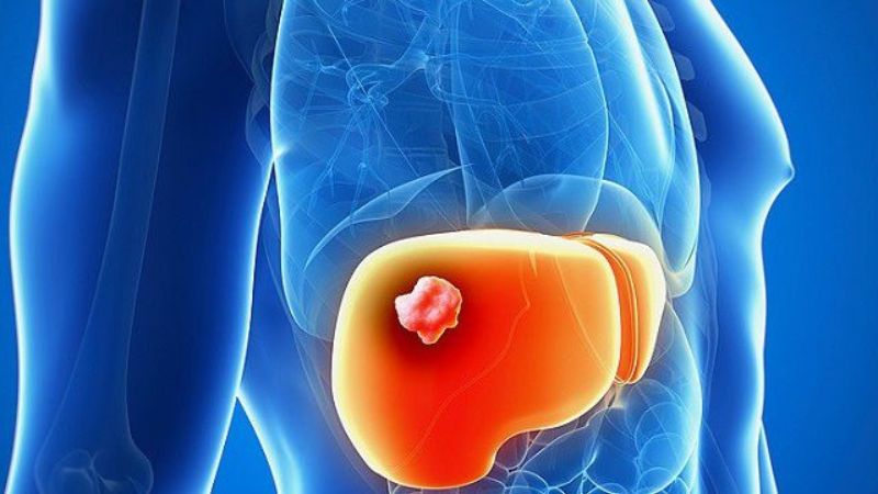 Tại Việt Nam, số người mắc ung thư gan chỉ đứng sau ung thư vú