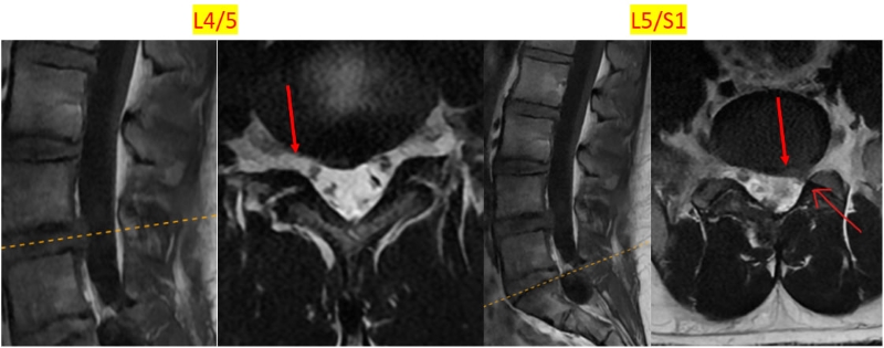 Hình ảnh chụp MRI cột sống thắt lưng cho thấy tình trạng bất thường vùng đĩa đệm  