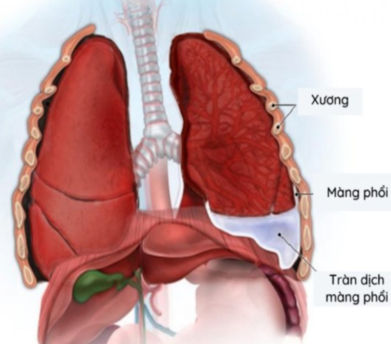 TDMP là tình trạng xuất hiện dịch trong khoang màng phổi nhiều hơn mức bình thường. Ảnh minh họa