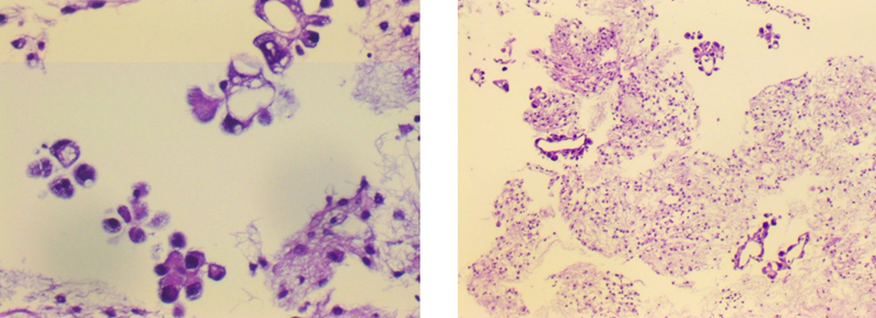 Xét nghiệm khối tế bào kết luận dịch nghi ngờ di căn