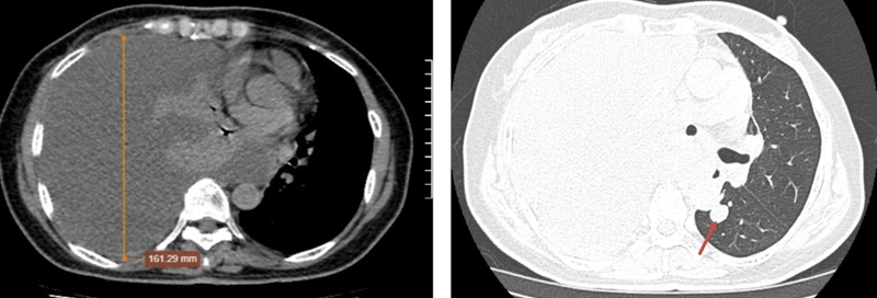 Hình ảnh tràn dịch khoang màng phổi phải mức độ nhiều và nốt đặc phổi trái phân thùy S6 sát trung thất