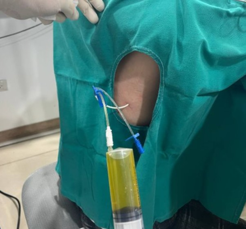 Hình ảnh bác sĩ chọc hút dẫn lưu khí màng phổi bằng catheter 2 nòng tại khoang liên sườn 7,8 đường nách sau