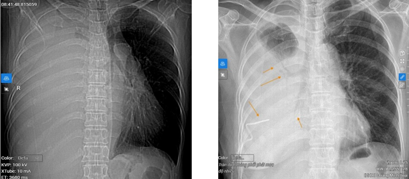 Hình ảnh trước khi dẫn lưu dịch màng phổi (ảnh trái) và sau khi dẫn lưu 1.000ml dịch màng phổi