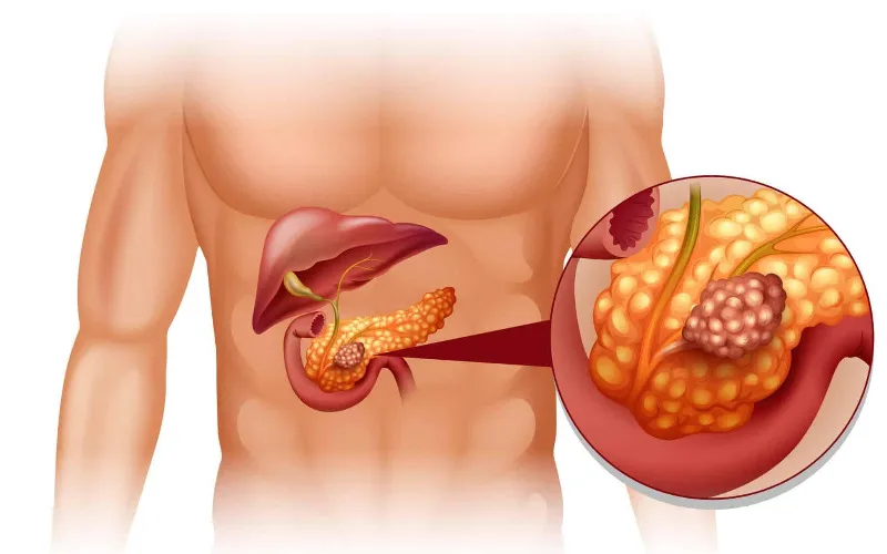 Tăng triglycerid máu là nguyên nhân khá phổ biến gây ra tình trạng viêm tụy cấp (Ảnh minh họa - Nguồn: Internet) 