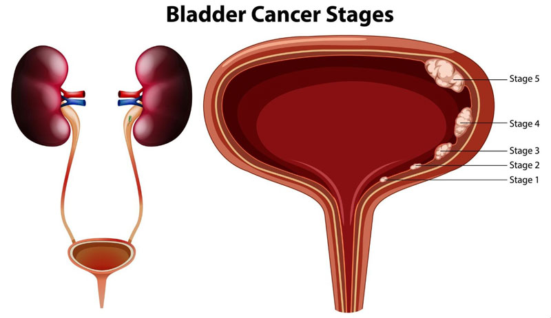 U bàng quang ác tính là một dạng ung thư đường tiết niệu - sinh dục