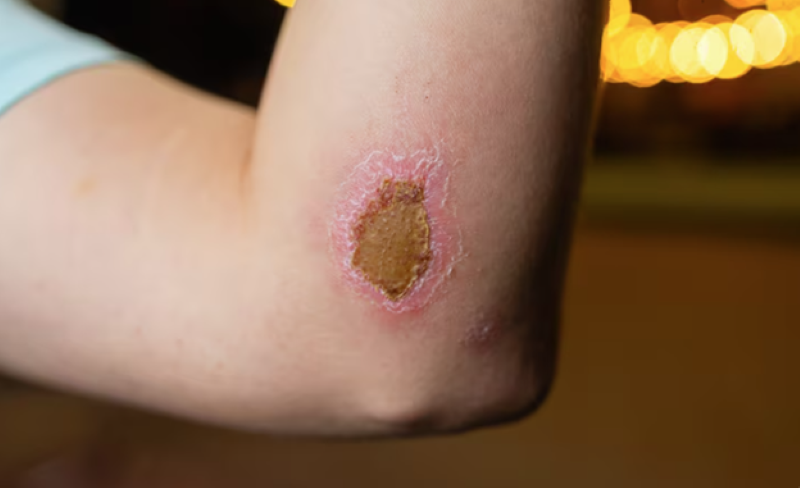 Vết thương có mủ và mùi hôi là dấu hiệu của tình trạng nhiễm trùng 
