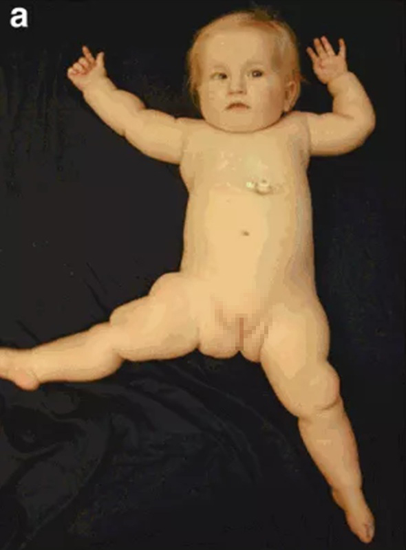 Trẻ nam sinh ra có hình thái cơ quan sinh dục giống nữ hoặc mơ hồ. Ảnh minh họa, nguồn Internet