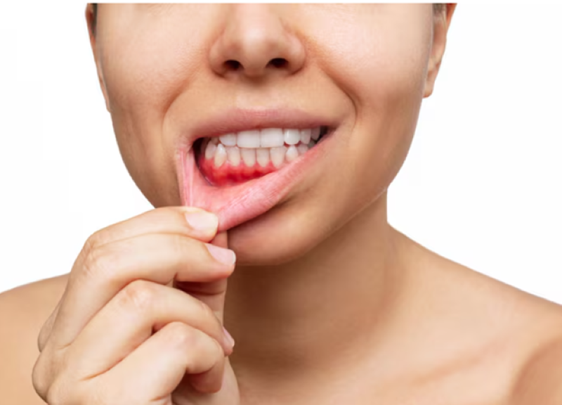 Khi mảng bám tích tụ lâu ngày, chúng có thể vôi hóa và hình thành cao răng, từ đó làm gia tăng nguy cơ viêm nướu