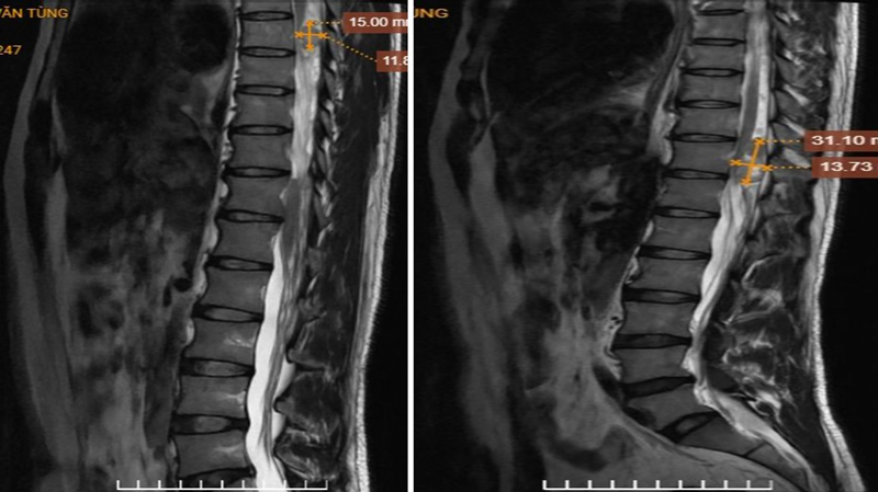 Hình ảnh khối trong ống sống vị trí T7, T11, cạnh phải lỗ tiếp hợp bên phải L1/2 trước và sau tiêm thuốc đối quang từ