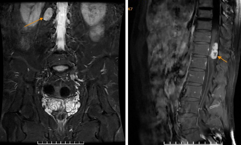 Hình ảnh khối trong ống sống vị trí T7, T11, cạnh phải lỗ tiếp hợp bên phải L1/2 trước và sau tiêm thuốc đối quang từ
