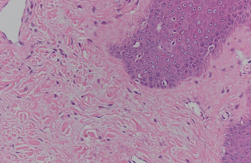 Hình ảnh mô bệnh học xác định, khối u của bệnh nhân là u xơ da lành tính 