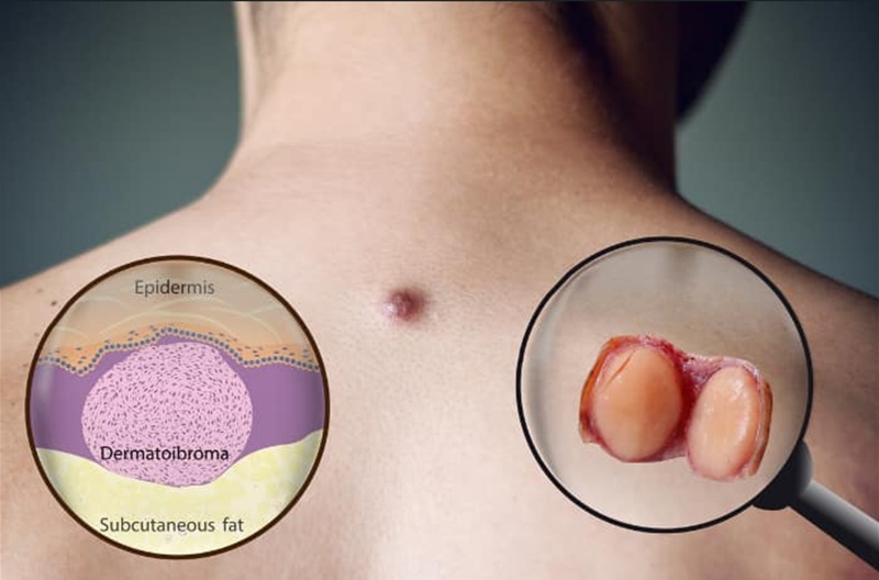 U xơ da là u lành tính nhưng có thể gây đau, vướng víu hoặc ảnh hưởng đến thẩm mỹ của người bệnh. Ảnh minh họa Internet 