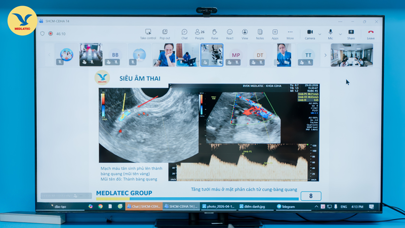 Hình ảnh trên siêu âm doppler cho thấy dấu hiệu cầu mạch máu và tăng sinh mạch máu mặt phân cách