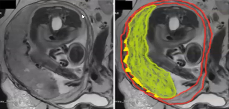 Hình ảnh MRI nhau cài răng lược thể Increta