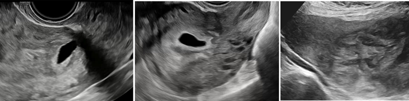 Dấu hiệu thai bám sẹo trên siêu âm 