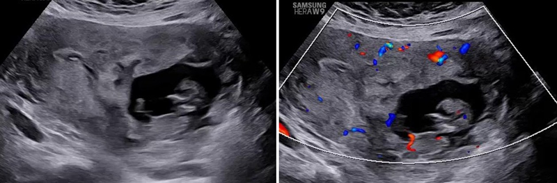 Dấu hiệu túi thai thấp 