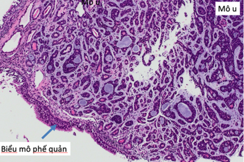 Hình ảnh vi thể xét nghiệm mô bệnh học của bệnh nhân  