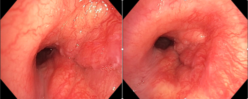 Hình ảnh nội soi phế quản: U sùi thâm nhiễm gây hẹp 1/3 dưới khí quản 