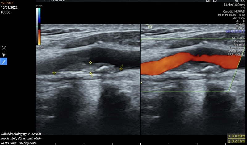 Siêu âm động mạch cảnh giúp phát hiện dấu hiệu bất thường tại một hoặc hai bên động mạch cảnh 