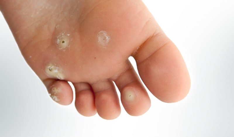 Mụn cóc ở chân có thể gây đau nhức và rất khó chịu