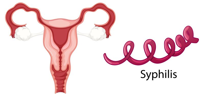Dấu hiệu giang mai ở nữ giới giai đoạn 1 các vết loét thường gặp ở môi lớn, môi bé hoặc cổ tử cung