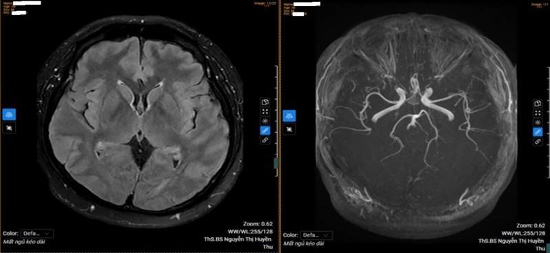 Kết quả chụp MRI sọ não của bệnh nhân