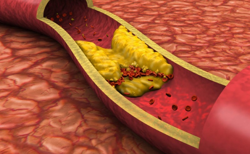 Tầm quan trọng của mỡ máu có nguy hiểm không hiệu quả và an toàn