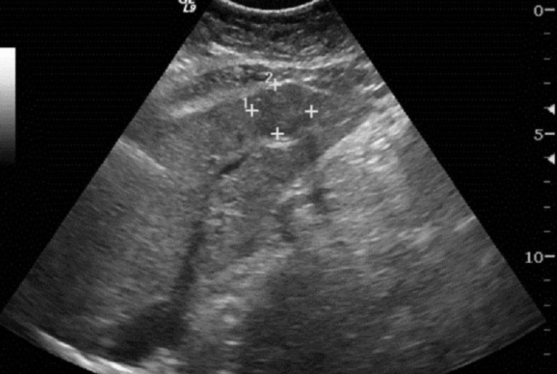 Siêu âm là pháp tầm soát đầu tay, không xâm lấn, chi phí thấp