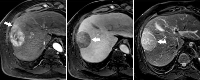 MRI cho độ nhạy cao hơn so với CT trong trường hợp tổn thương nhỏ <1cm