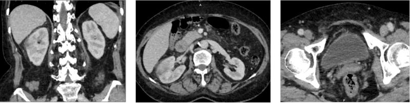 Hình ảnh theo dõi viêm thận bể thận bên phải trên MRI