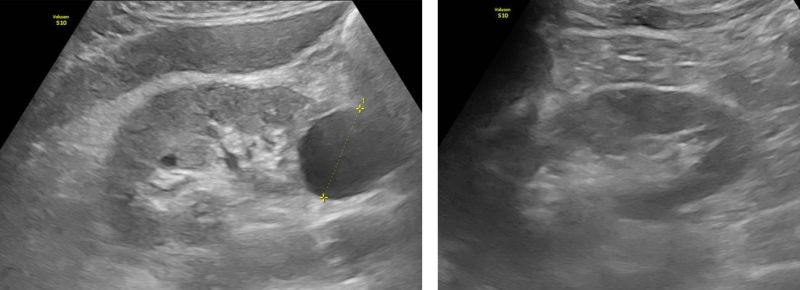 Hình ảnh nốt vôi hóa gan phải, nang thận phải