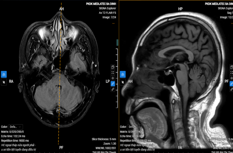 Kết quả chụp MRI sọ não của bệnh nhân phát hiện bất thường  