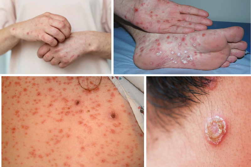 Giang mai có thể diễn tiến âm thầm trong nhiều năm mà không có triệu chứng, nhưng hậu quả lại rất nghiêm trọng. Ảnh minh họa