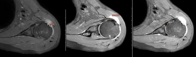 Hình ảnh chụp MRI khớp vai của bệnh nhân  