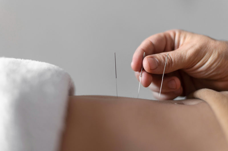 Kỹ thuật châm cứu cơ bản sử dụng kim châm truyền thống