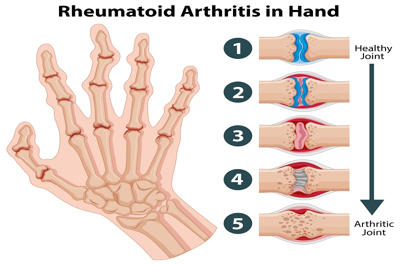 Bệnh nhân viêm khớp dạng thấp giai đoạn đầu có thể bị đau cổ tay nhưng không sưng