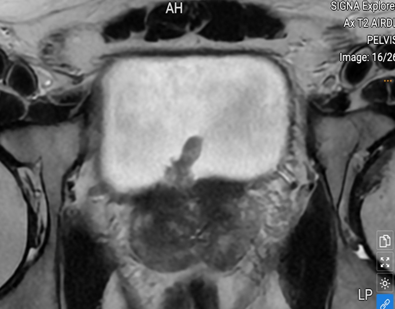 Chụp MRI phát hiện khối tổn thương ở thành bàng quang