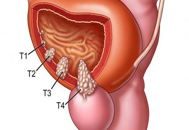 U bàng quang phần lớn là ác tính. Ảnh minh họa
