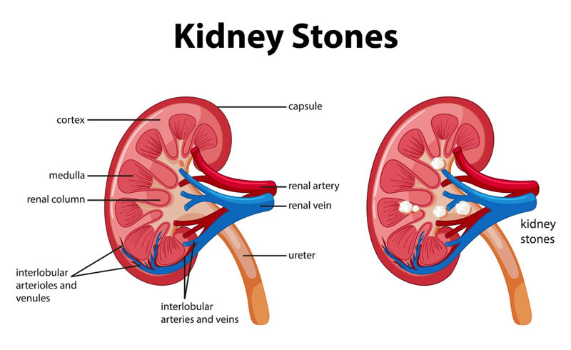 Bệnh suy thận do nhiều nguyên nhân khác gây nên, bao gồm việc bị sỏi thận