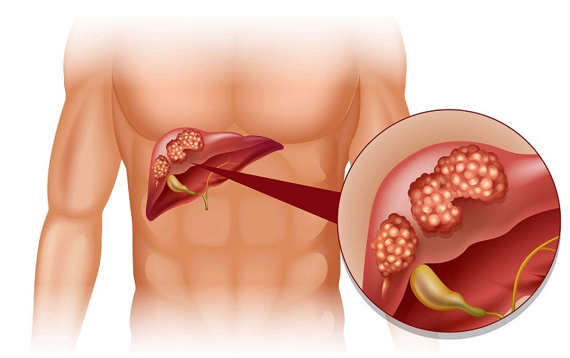 Kết quả siêu âm có thể cho thấy những bất thường tại gan