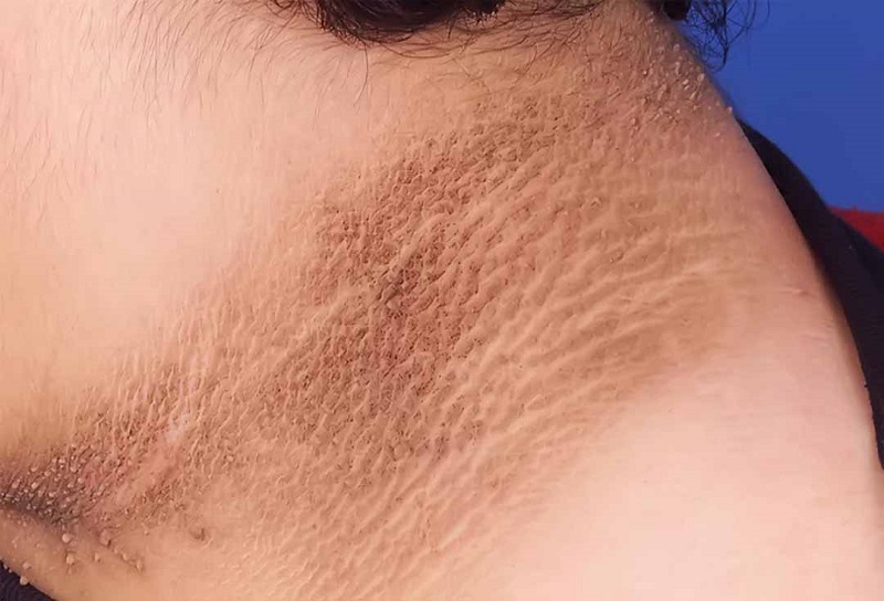 Bệnh gai đen có thể là nguyên nhân khiến da vùng cổ bị thâm đen