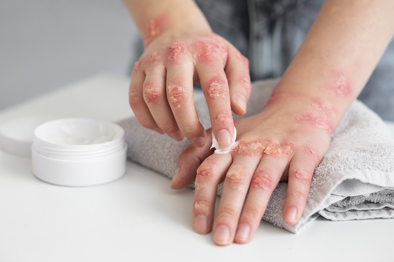 Dùng thuốc theo chỉ định kết hợp dưỡng ẩm da hàng ngày giúp kiểm soát triệu chứng viêm da cơ địa