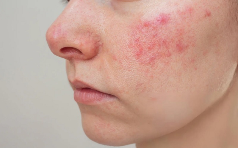 Hình ảnh mô phỏng tổn thương da thường gặp ở lupus ban đỏ