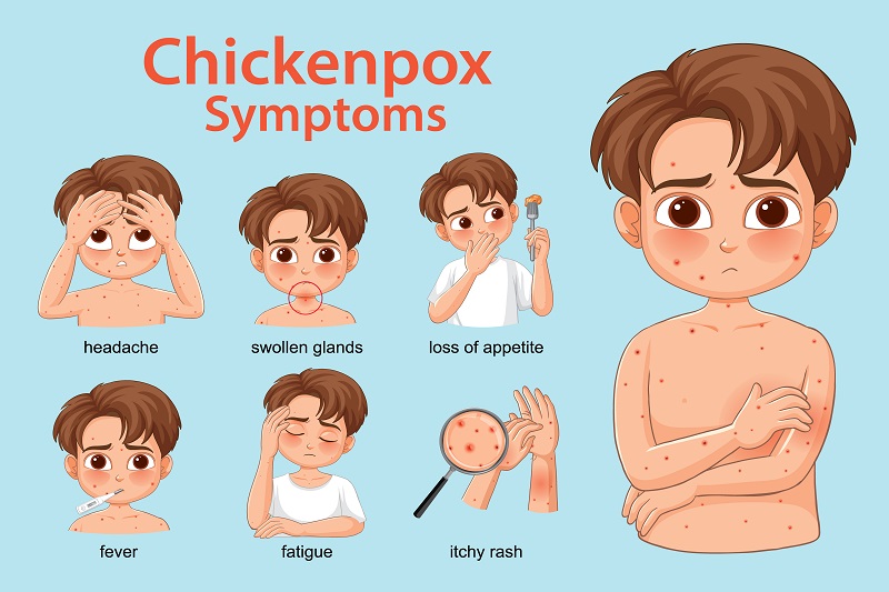 Hình ảnh mô phỏng các biểu hiện thủy đậu