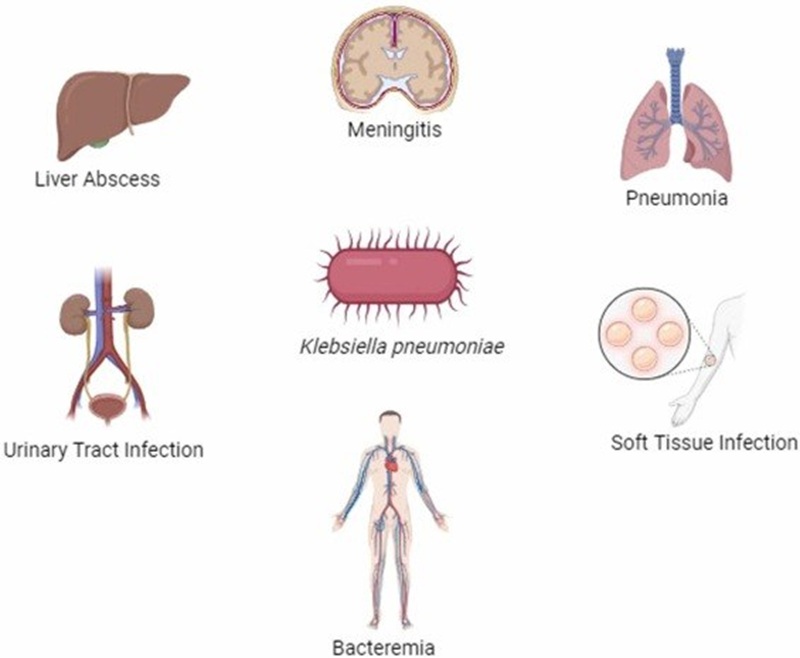 Nhiễm khuẩn huyết do Klebsiella pneumoniae có thể đi bệnh đến nhiều cơ quan trong cơ thể. Ảnh minh họa, nguồn Internet